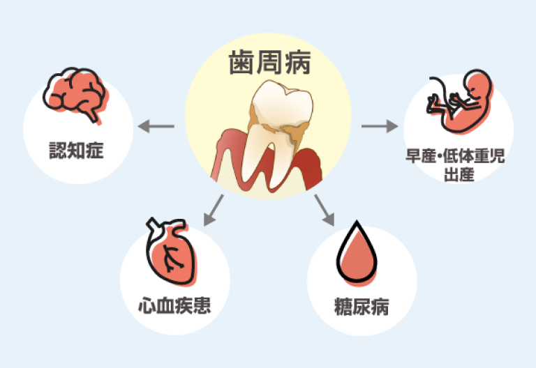 妊娠中は歯周病予防が非常に重要です